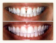 teeth bonding gap gone gaping uncategorized snobessentials